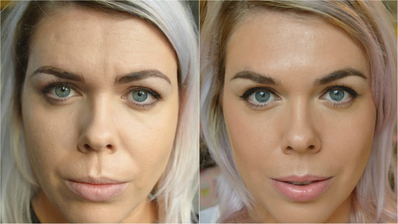 baby botox